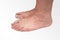 Varus valgus and Hallux valgus, bunion on white background.