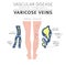 Vascular diseases. Varicose veins symptoms, treatment icon set.