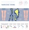 Vascular diseases. Varicose veins symptoms, treatment icon set.