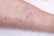 Vascular marks on the skin from varicose veins, vascular pattern on the skin, close-up, phlebeurysm, problem, white background