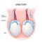 Vasectomy. Open-ended method and ligating suturing.