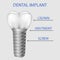 Vector 3D illustration of the structure of the dental implant of