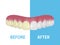 Vector Background with 3d Realistic Render Denture Set Closeup Isolated. Dentistry and Orthodontics Design. Human Teeth