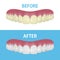 Vector Background with 3d Realistic Render Denture Set Closeup Isolated. Dentistry and Orthodontics Design. Human Teeth