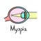 Vector design of myopia and eye icon. Web element of myopia and cornea stock vector illustration.