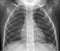 Vector flat icon x-ray of human thorax. Anatomy