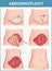 Vector illustration of a abdominoplasty and Lipectomy Procedures
