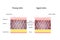 Vector illustration of age-related changes in the skin. Comparison of young and old skin. Structure human skin with