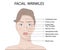 Vector Illustration of Common Types of Facial Wrinkles, cosmetic surgery, woman facial treatment concept