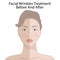 Vector Illustration of Common Types of Facial Wrinkles, cosmetic surgery, woman facial treatment concept