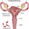 Vector illustration endometriosis. Gynecological disease. Inflammation of the uterus. Diseases of female organs.