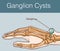 Vector illustration of a Ganglion cyst