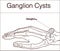 Vector illustration of a Ganglion cyst