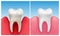 Vector illustration of gum disease -  periodontitis in compare with healthy white tooth