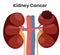Vector illustration of the kidney cancer. The tumor is affecting left kidney while right kidney is normal