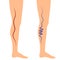 Vector illustration leg veins