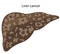 Vector illustration  liver disease