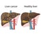 Vector illustration  liver disease