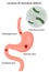 Vector illustration of the location of ulcerative defects