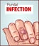 Vector illustration of a Nail Fungal Infection