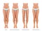 Vector illustration of pediatric orthopedics. valgus and varus