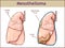 vector illustration of a Pleural mesothelioma