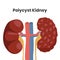 Vector illustration of the polycystic kidney disease,