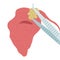 Vector illustration of removing a stone from the parotid salivary gland