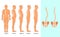 Vector illustration of spinal deformity types: scoliosis, lordosis and kyphosis. Body posture defect. Infographics of spine diseas