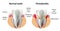 Vector image tooth Periodontitis disease