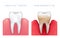 Vector medical illustration of realistic healthy tooth and periodontitis disease