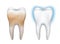 Vector realistic dirty and clean tooth model - whitening, dental hygiene, health