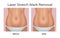 Vector realistic illustration of before and after laser strechmarks removal