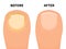 Vector toe nail before and after fungal disease