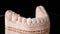 Veneers for teeth on jaw model. Shot on black background. Artificial teeth. Ceramic dentures and crowns. Zirconium crown