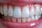 veneers treatment, Yellow Teeth after whitening. Happy smiling person. Generation AI