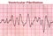 Ventricular Fibrillation - Deadly Heart Arrhythmia