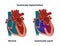 Ventricular septal defect with normal heart anatomy. Illustration of  the congenital heart defect