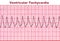 Ventricular Tachycardia - Deadly Heart Arrhythmia