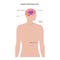 ventriculoperitoneal shunt concept