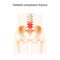 Vertebral compression fracture