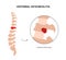 Vertebral osteomyelitis poster