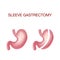 Vertical Sleeve Gastrectomy. Weight Loss Surgery .Anatomical.