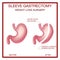 Vertical Sleeve Gastrectomy. Weight Loss Surgery .Anatomical.