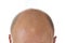View of bald man`s head