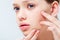 View of displeased teenage girl having acne on face isolated on grey