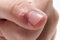 Viral wart verruca on the finger close up on white background.