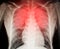 Virus destroys human lungs the lnflamed radiograph