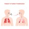 Virus. human-to-human transmission. contamination of virus. Coronavirus in lungs