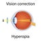 Vision Correction of Hyperopia Illustration. Eyesight Disorders. Eyes Defect Corrected by Convex Lens Concept. Detailed
